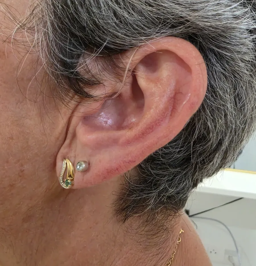 Oreille appareillée avec un contour discret, appareillage réalisé au cabinet