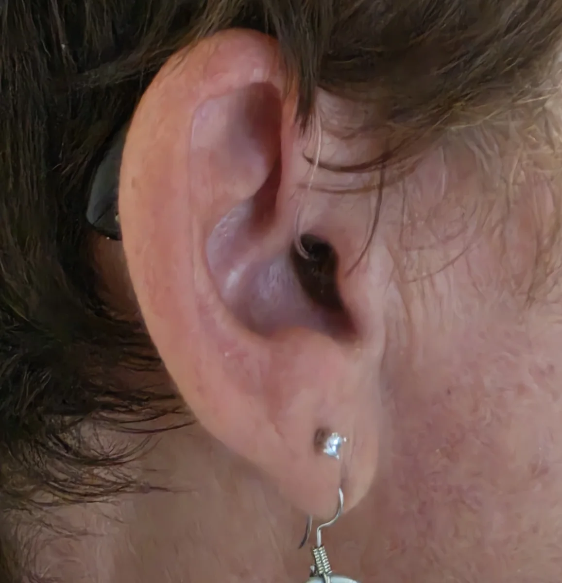Oreille appareillée : appareil auditif quasiment invisible derrière l'oreille