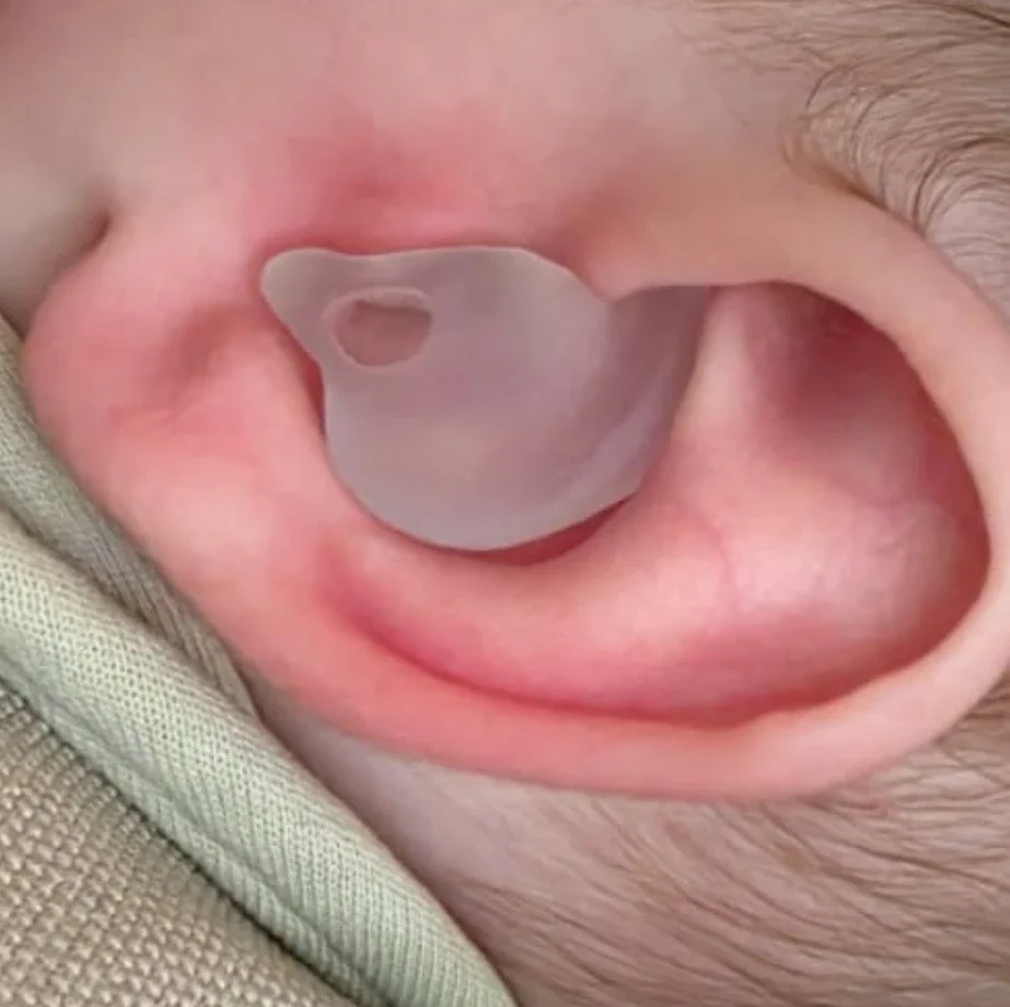 Conformateur d'oreille sur mesure en place dans la conque d'un nourrisson